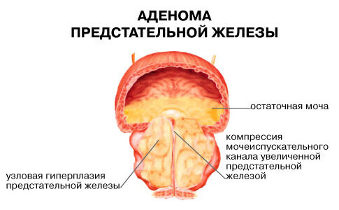 Можно ли делать массаж простаты при простатите и аденоме?