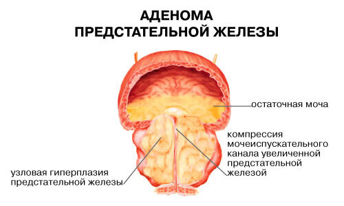 Можно ли делать массаж простаты при простатите и аденоме?