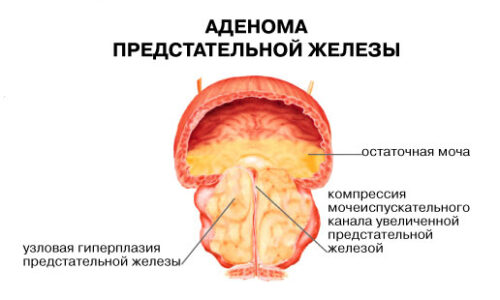 Каковы последствия операции по удалению аденомы простаты?
